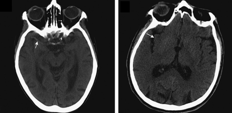 hyperdense mca sign and insular ribbon sign ct