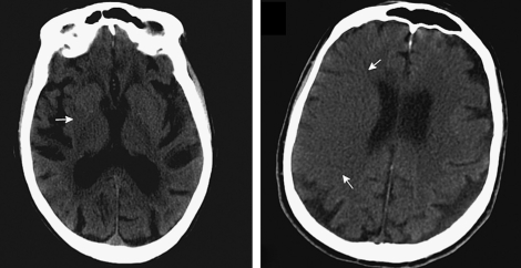obscure basal ganglia and focal cerebral edema ct